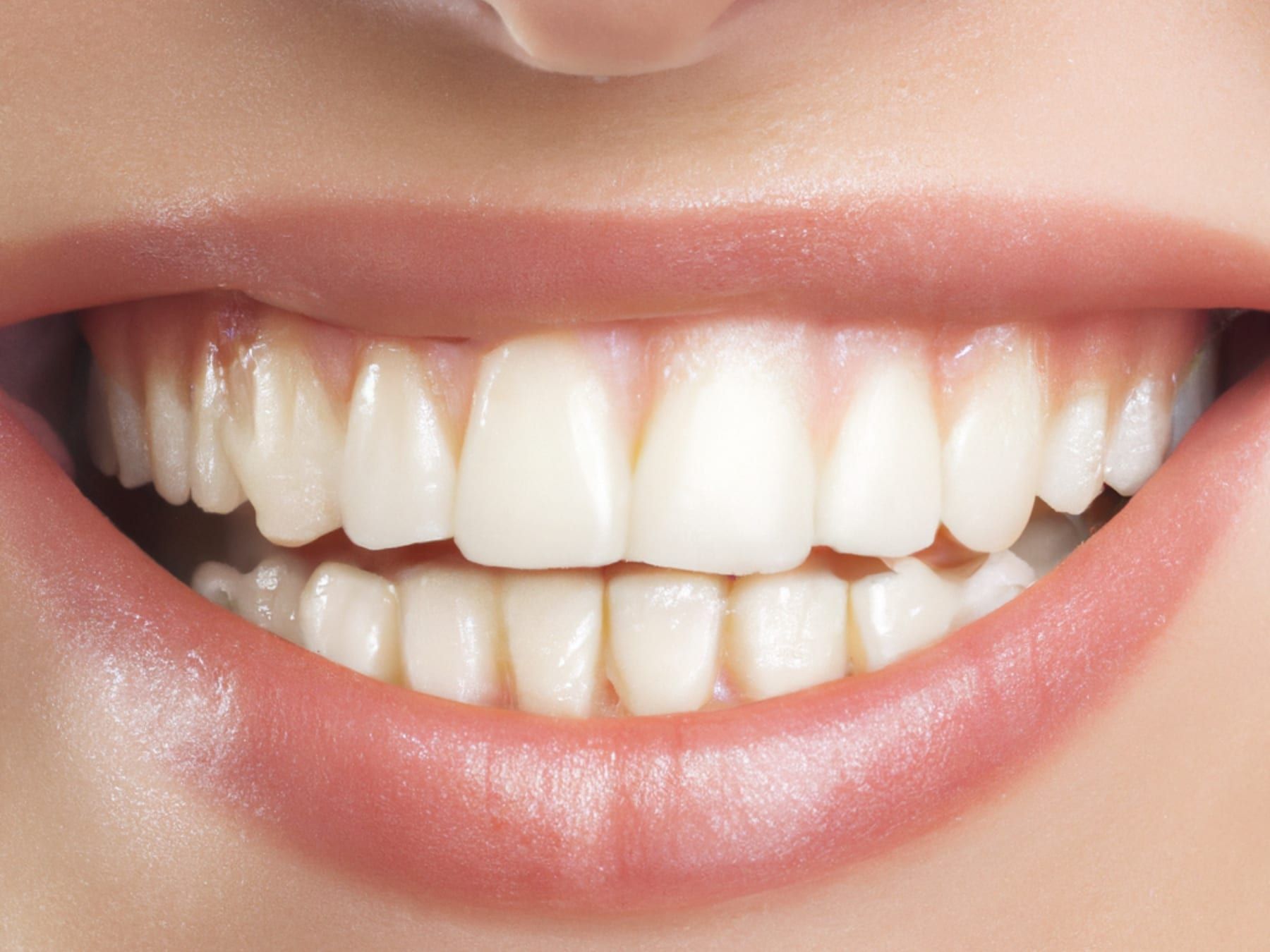 After: Whitening + veneers
