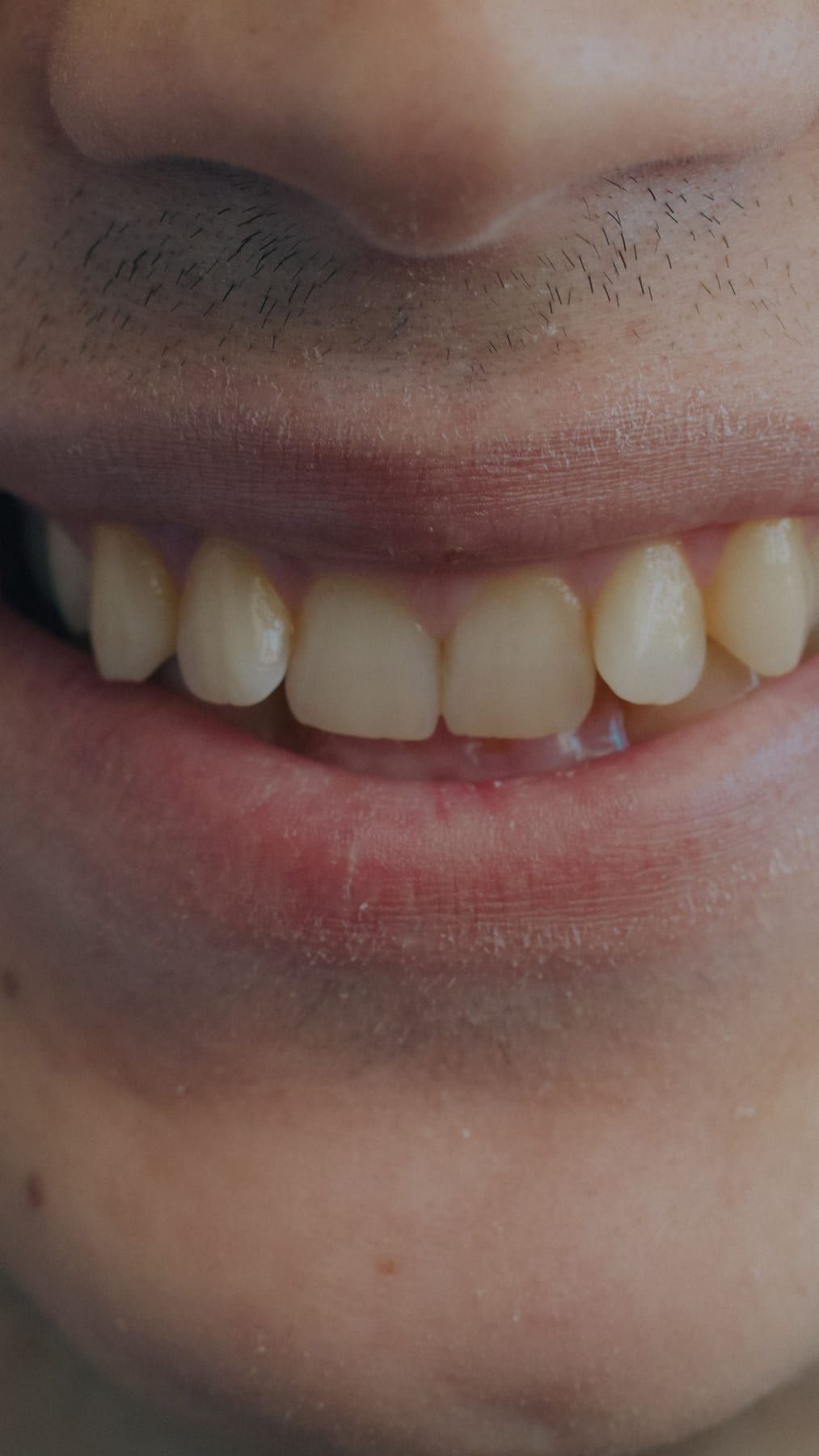 Before: Whitening + veneers