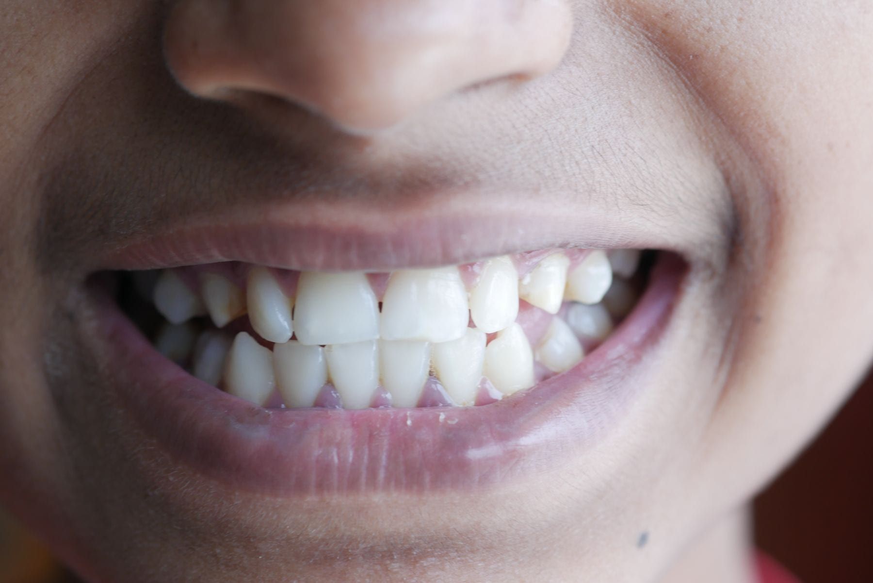Before: Clear aligners