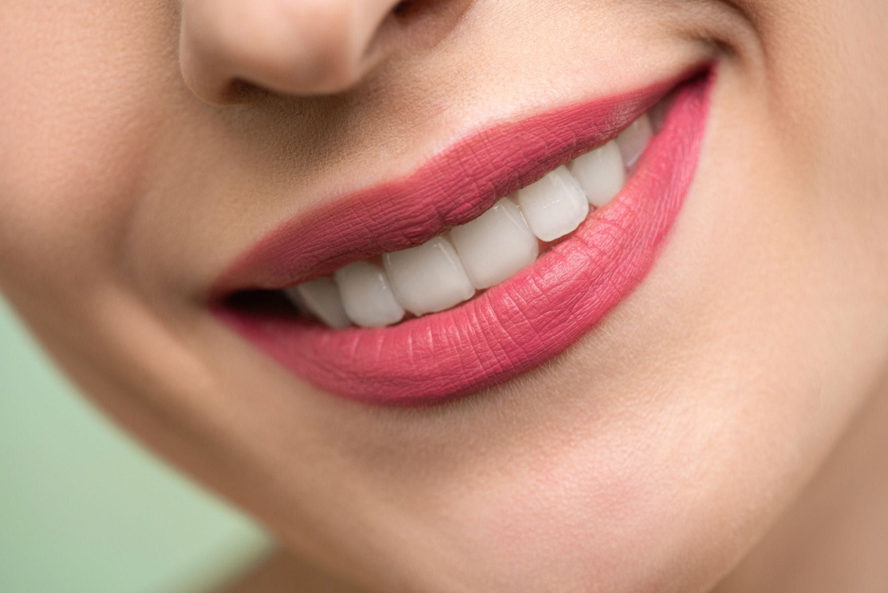 After: Professional whitening