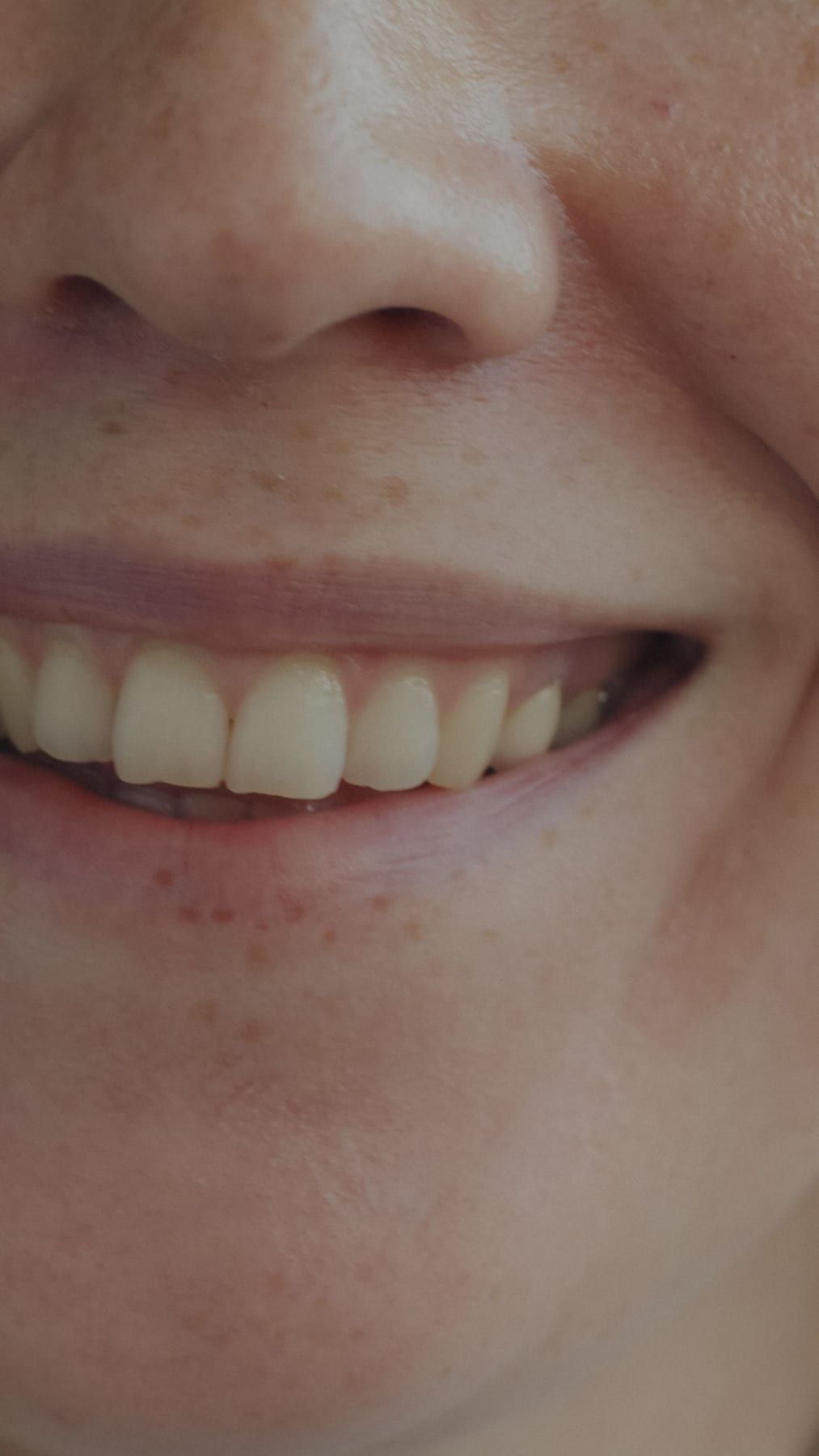 Before: Professional whitening