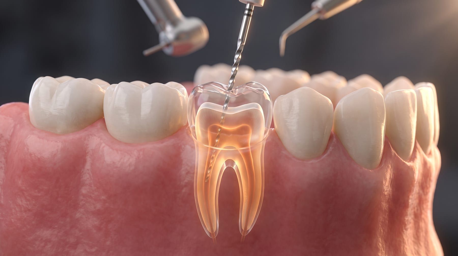 Endodontics (Root Canals) at Ujyalo Dental