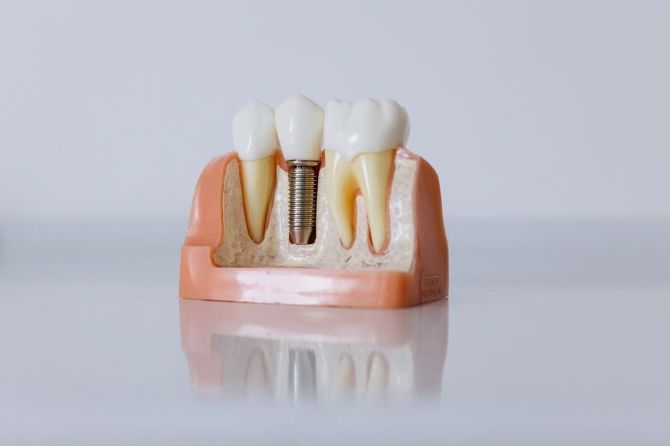 Dental Implants at Ujyalo Dental