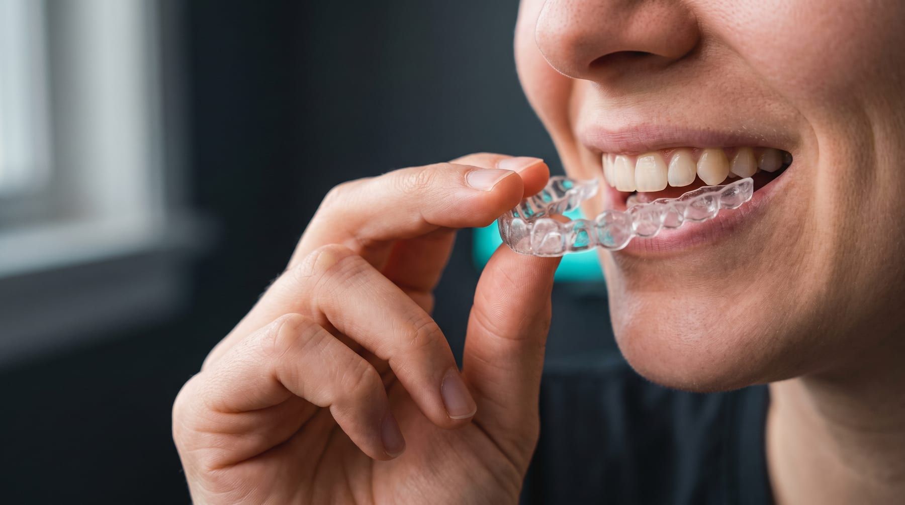 Orthodontics at Ujyalo Dental