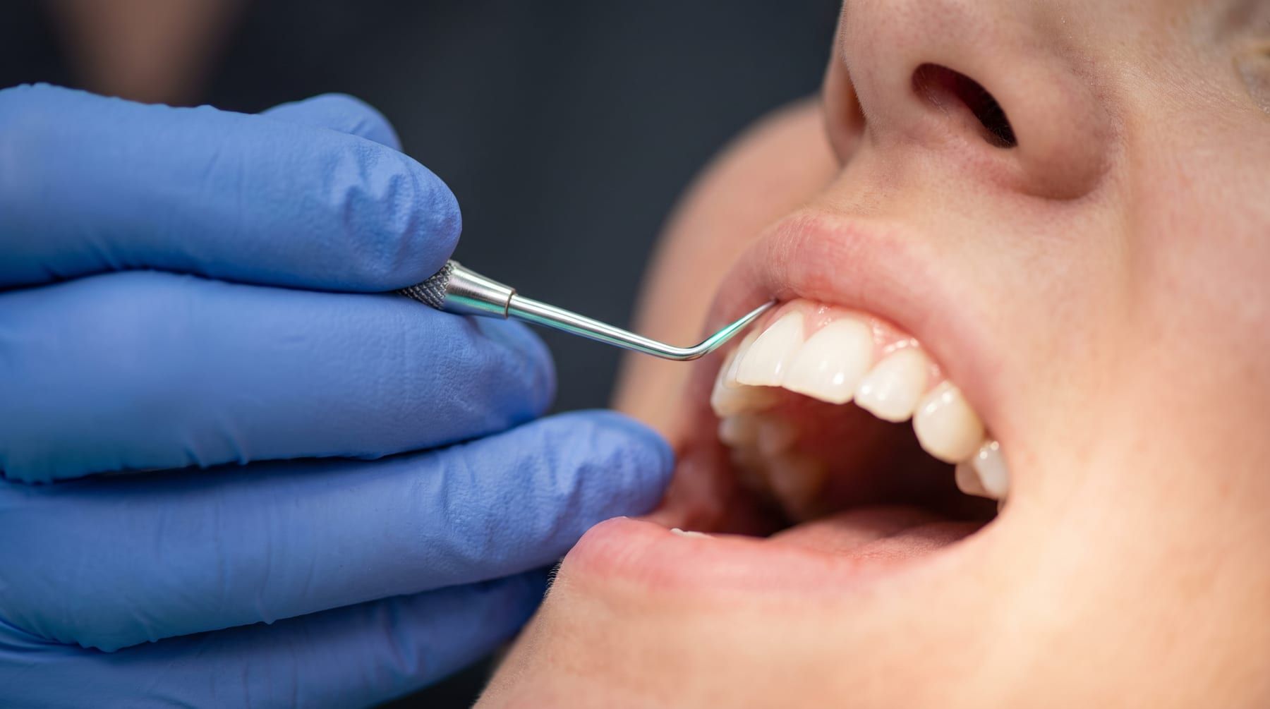 Periodontics (Gum Care) at Ujyalo Dental
